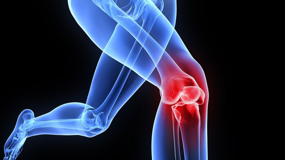 problemy z kolanami spowodowane artrozą