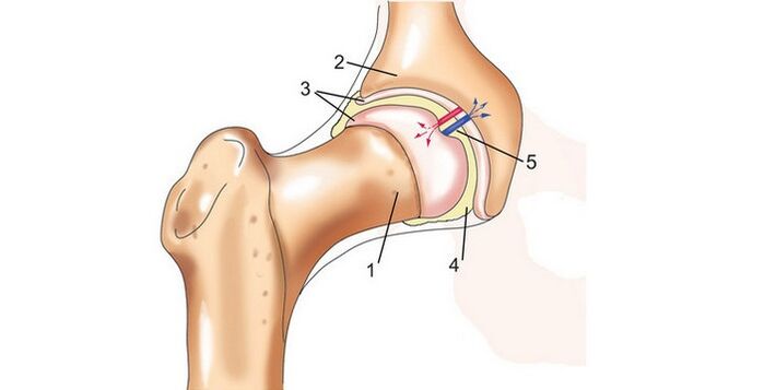 stawu biodrowego i artrozy