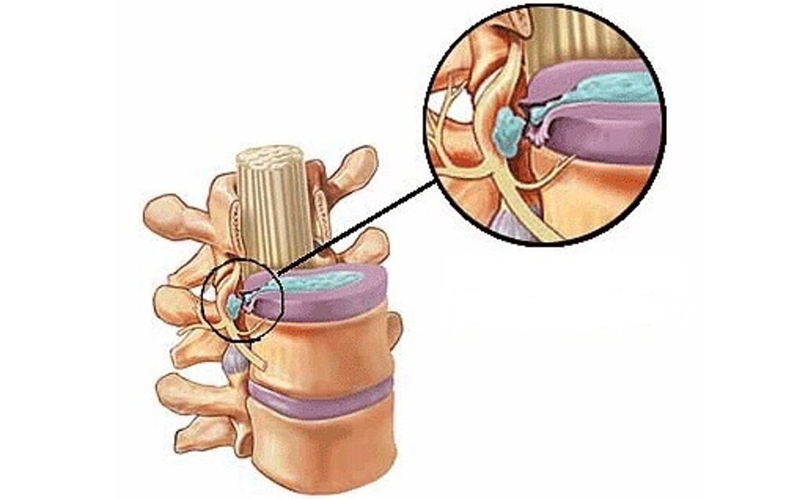 przepuklina międzykręgowa z osteochondrozą klatki piersiowej